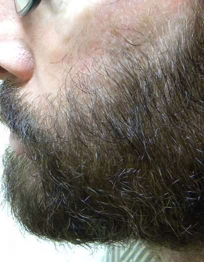 Facial hair beard transplant  Hair Transplant Guwahati