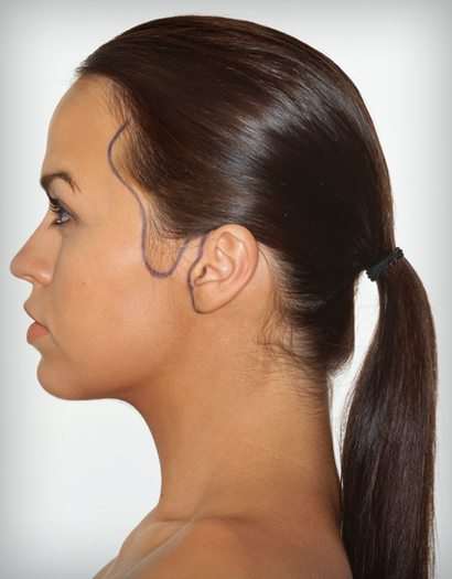 Facelift Scarring Tempus Hair