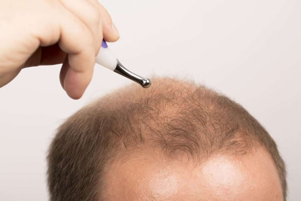 An Affordable Hair Transplant that Doesn’t Sacrifice Quality Tempus Hair