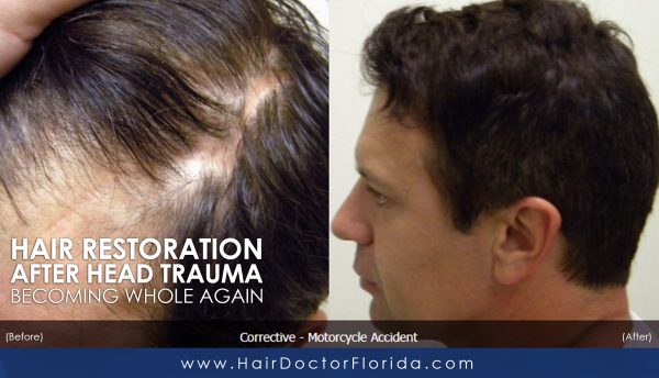 See Me, Not My Scar – Restoring Hair to a Head Trauma Patient Other  Surgeons Turned Away