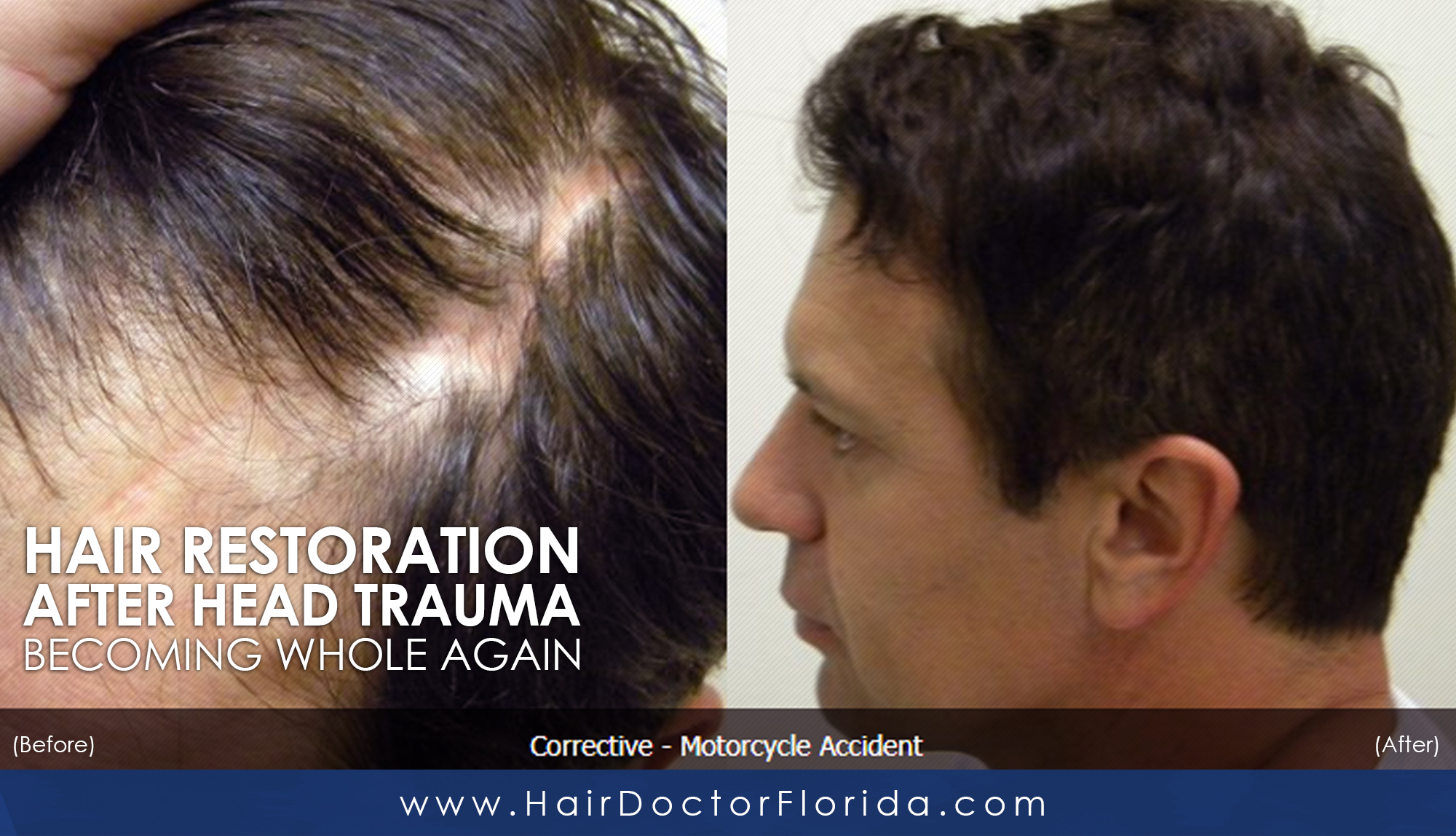See Me, Not My Scar – Restoring Hair to a Head Trauma Patient Other
